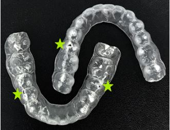 Retainers damaged by grinding or bruxism.