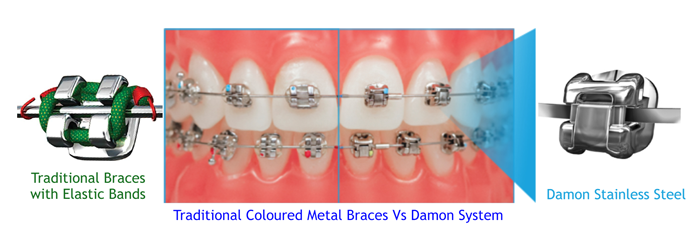 Conventional Metal Braces Vs Damon Metal Braces