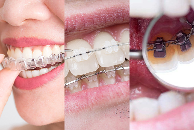 Invisalign, Ceramic or Lingual braces: Which is best?