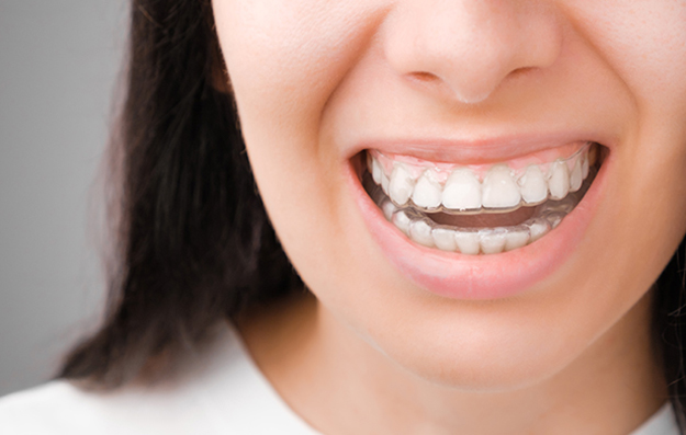 Invisalign Clear Braces Aligners 