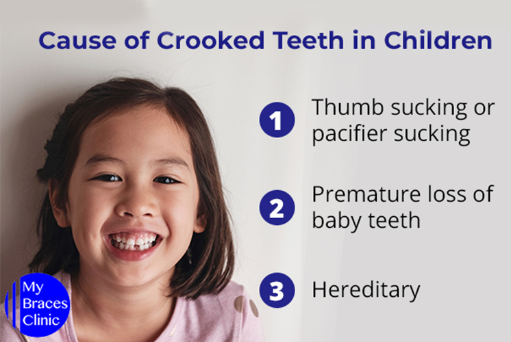 Cause Of Crooked Teeth In Children