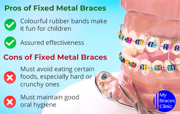 Pros OF Fixed Metal Braces