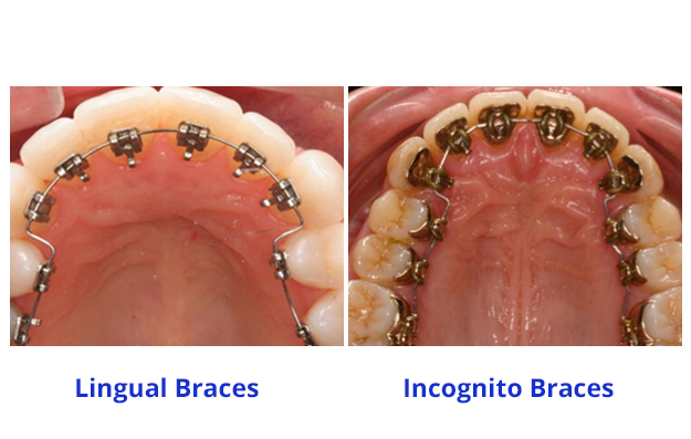 Incognito Lingual Braces treatment process