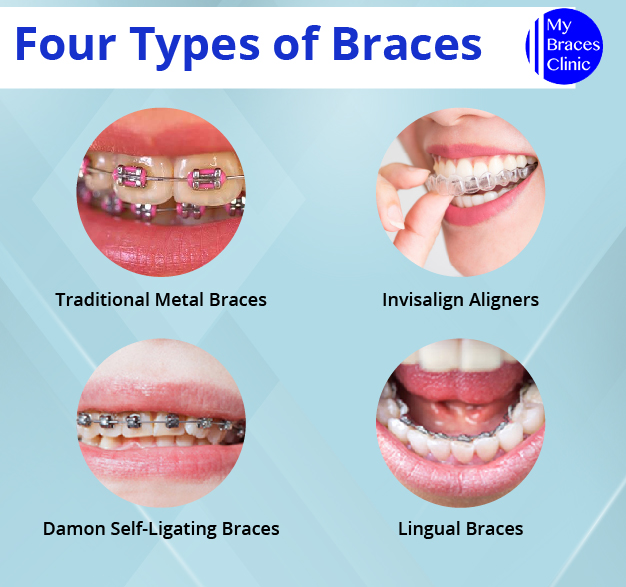 A Complete Guide to Braces Treatment in Singapore