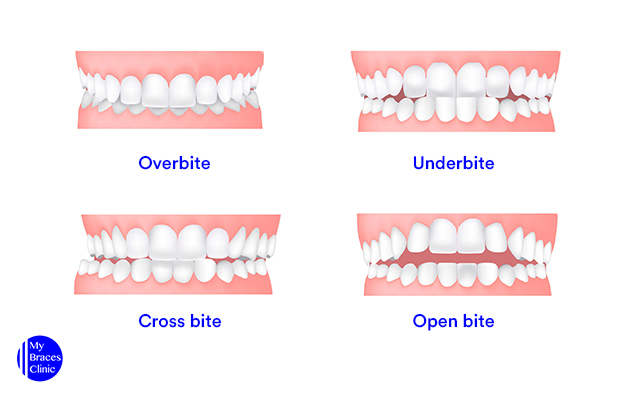 Overbite, Underbite, Severe Crossbite, and Open bite