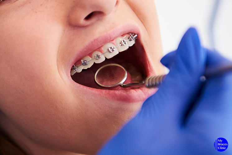 4 Questions to Ask Your Orthodontist at Your First Braces Consultation