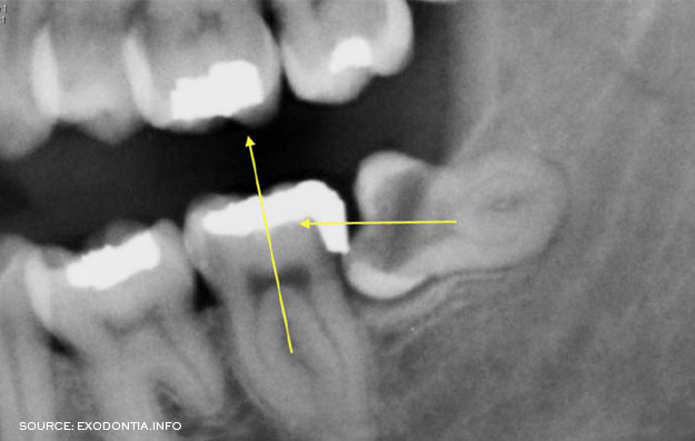 Horizontal Impaction