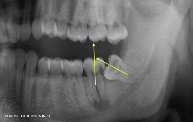 Mesial Impaction