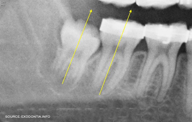 Vertical Impaction