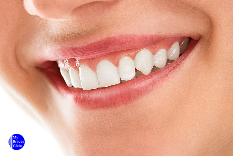 How Straightening Your Teeth Helps in Long Run