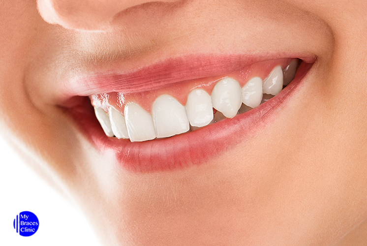 Long-term Health Benefits of Having Straight Teeth