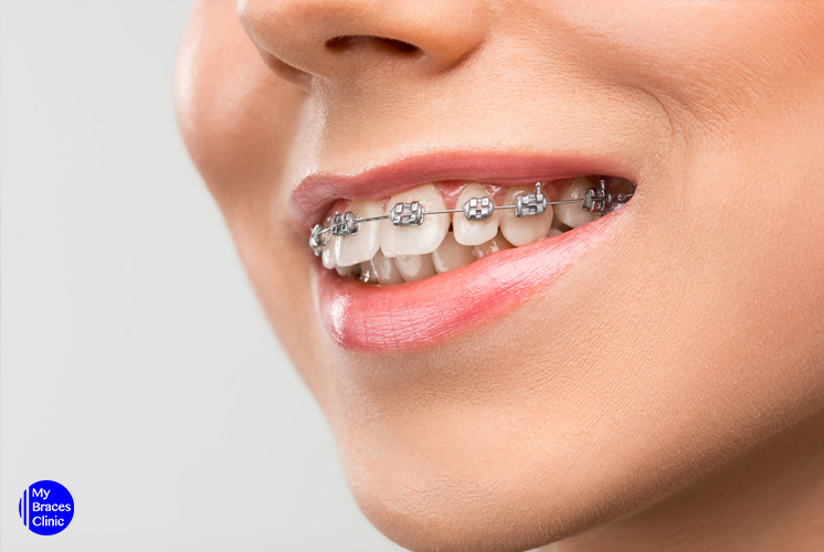 5 Types of Dental Braces: Their Pros and Cons