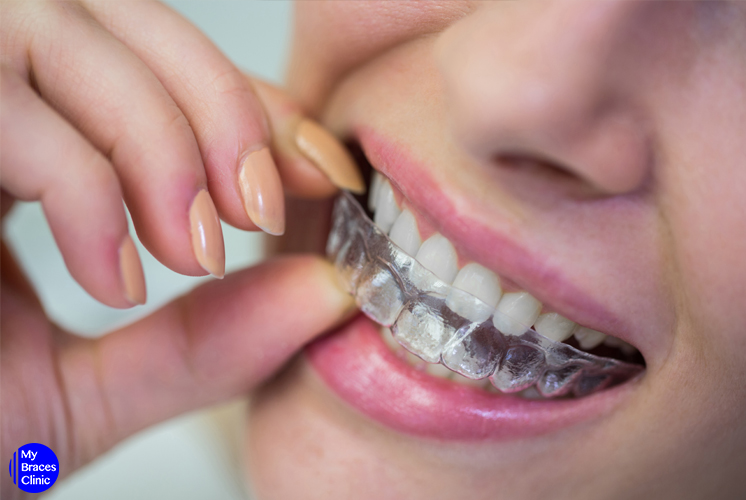 5 Misconceptions of Invisalign