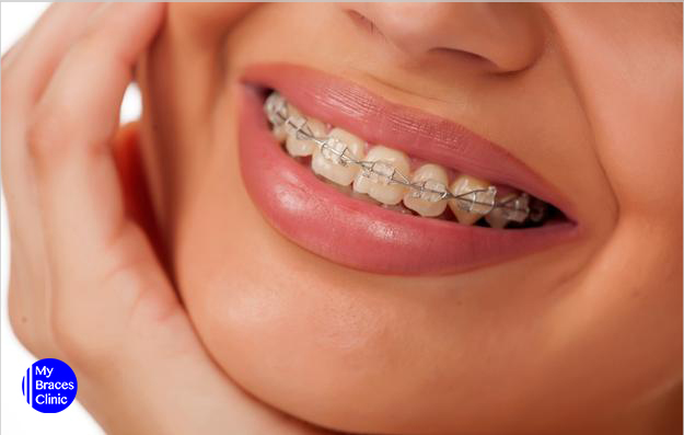 Ceramic Braces-Braces Singapore