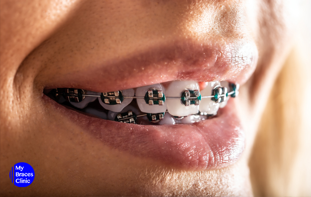 Metal Braces-Braces Singapore