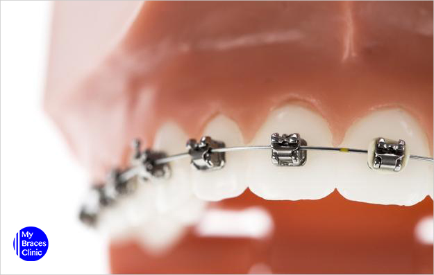 Self-Ligating Braces-Braces Singapore