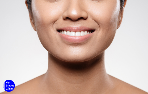 A woman smiling with clean and straight teeth-Invisalign Singapore Cost