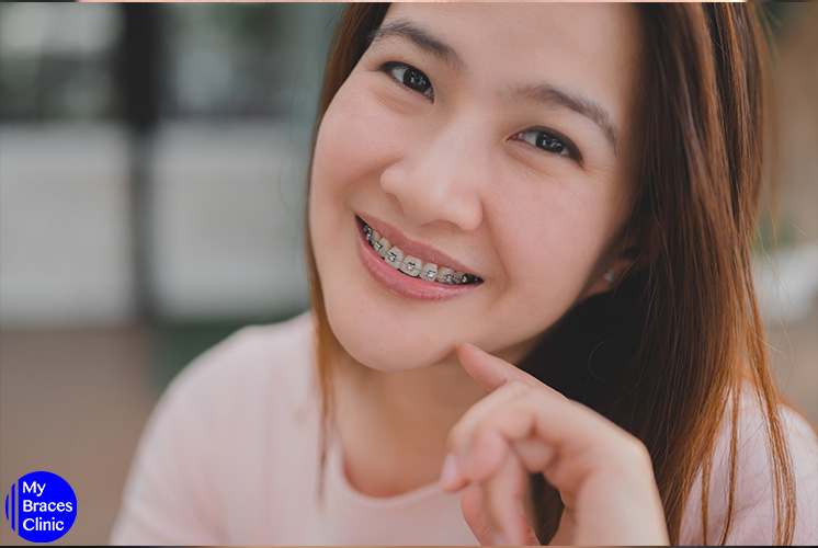 Are You Too Old for Braces How is Adult Treatment Different