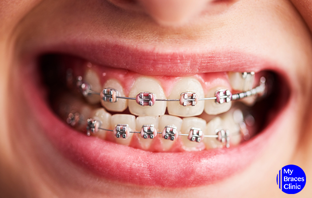 Dental Braces for Misaligned Teeth