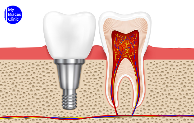 Dental Implants to Replace Severely Damaged