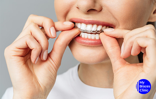 All You Need to Know About Invisalign Clear Aligners