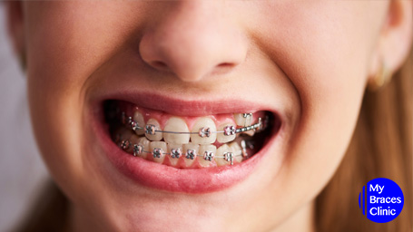 4 Problems You May Face with Orthodontic Solutions and How To Solve Them