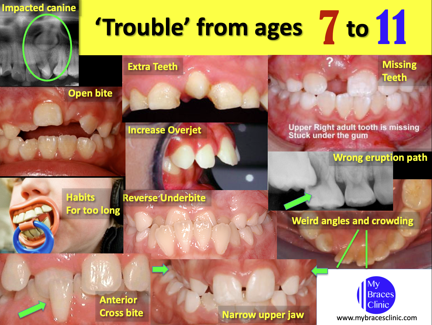 Type of orthodontic problems in a young child
