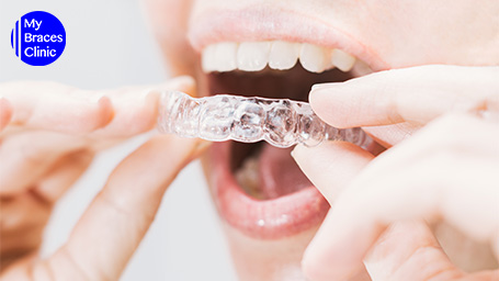 Straightening Your Teeth with Invisalign Benefits You'll Enjoy