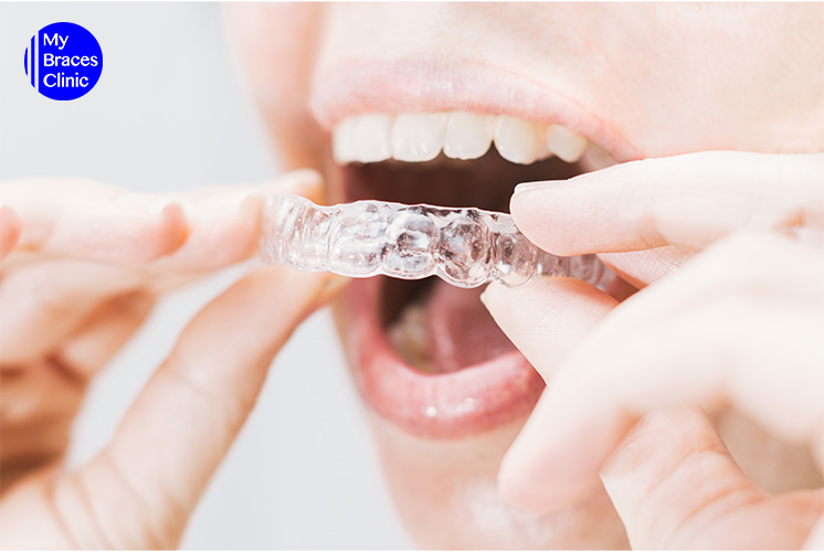 Straightening Your Teeth with Invisalign Benefits You'll Enjoy