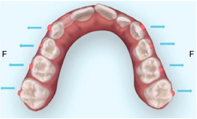 Invisalign First