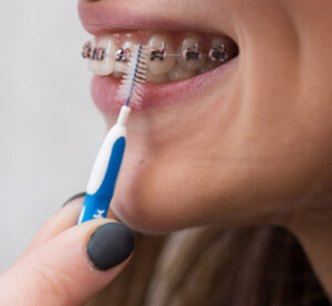 interdental brush and braces