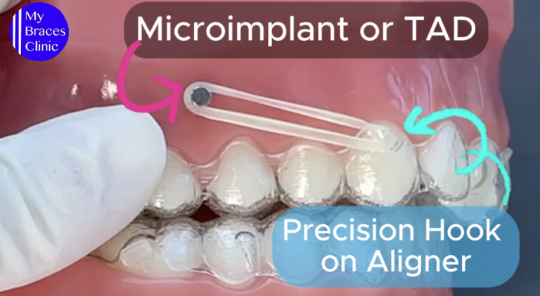 Elastics Inv Elastics for Invisalign | Invisalign Price In Singapore - MyBracesClinic