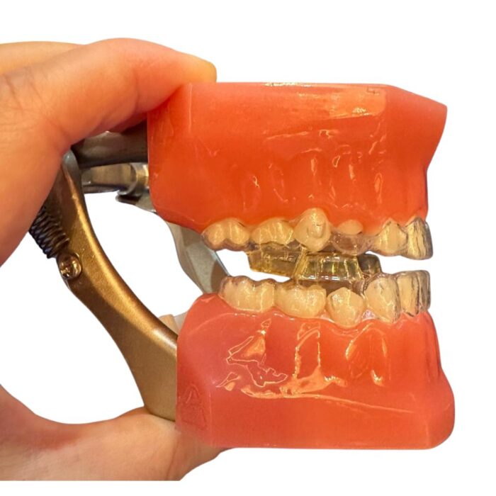 Ma Phase Invisalign Invisalign Mandibular Advancement for Class II Correction
