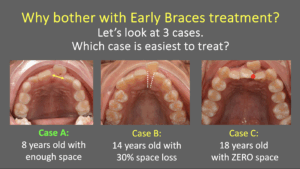 When should my child start braces?