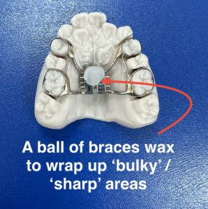 Braces wax and palatal expanders