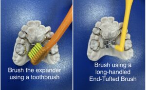 how to clean Hyrax palatal expander