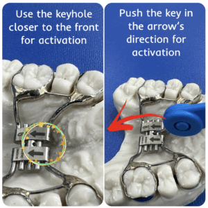 activating Hyrax palatal expander