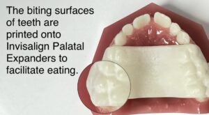 Close up view of the biting surfaces of an Invisalign Palatal Expander.