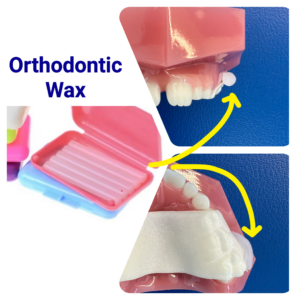 Using Braces wax with Invisalign Palatal Expander
