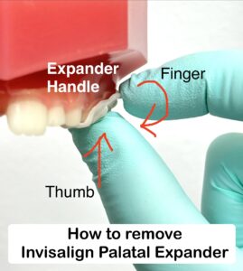 how to remove Invisalign palatal expander