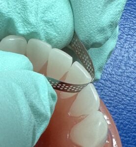 interproximal reduction IPR